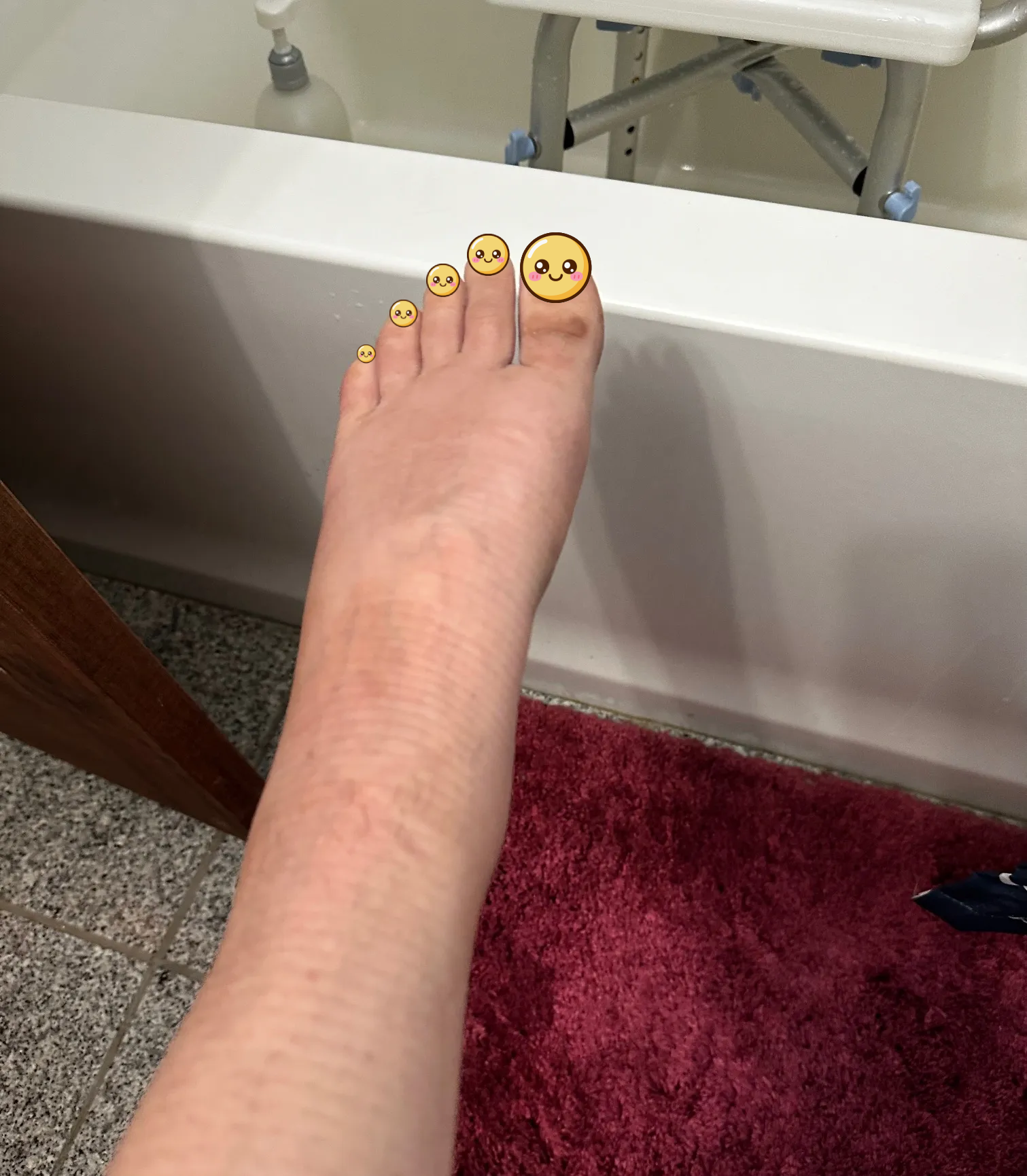 Calcaneal (heel) fracture ORIF update.